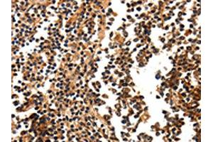 The image on the left is immunohistochemistry of paraffin-embedded Human tonsil tissue using ABIN7190676(FOXB2 Antibody) at dilution 1/5, on the right is treated with synthetic peptide. (FOXB2 Antikörper)