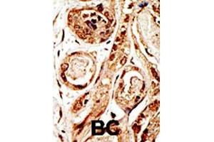 Formalin-fixed and paraffin-embedded human cancer tissue reacted with the primary antibody, which was peroxidase-conjugated to the secondary antibody, followed by AEC staining. (SENP3 Antikörper  (N-Term))