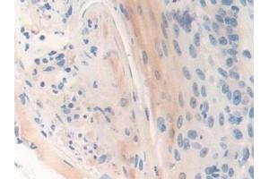 Detection of CENPI in Human Skin cancer Tissue using Polyclonal Antibody to Centromere Protein I (CENPI) (CENPI Antikörper  (AA 292-528))