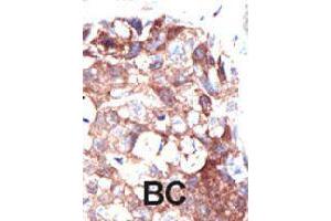 Formalin-fixed and paraffin-embedded human cancer tissue reacted with UBQLN1 polyclonal antibody  , which was peroxidase-conjugated to the secondary antibody, followed by DAB staining. (Ubiquilin 1 Antikörper  (N-Term))
