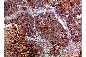 Immunohistochemical analysis of paraffin-embedded human-lung-cancer, antibody was diluted at 1:200 (MLL/KMT2A Antikörper  (AA 3850-3900))