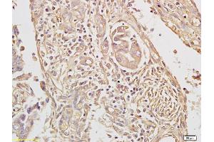 Formalin-fixed and paraffin embedded human colon cancer labeled with Anti-TAK1/MAP3K7 Polyclonal Antibody, Unconjugated (ABIN701185) followed by conjugation to the secondary antibody and DAB staining (TR4 Antikörper  (AA 560-600))