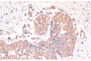 Immunohistochemistry of paraffin-embedded Human mammary cancer using Caspase-3 Polyclonal Antibody at dilution of 1:200 (40x lens). (Caspase 3 Antikörper)