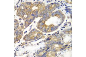 Immunohistochemistry of paraffin-embedded human gastric cancer using PFKM antibody. (PFKM Antikörper)