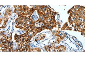 Immunohistochemistry of paraffin-embedded Human lung cancer using ALDH6A1 Polyclonal Antibody at dilution of 1:45 (ALDH6A1 Antikörper)