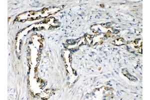 Anti-CXCR1 antibody, IHC(P) IHC(P): Human Lung Cancer Tissue (CXCR1 Antikörper  (N-Term))