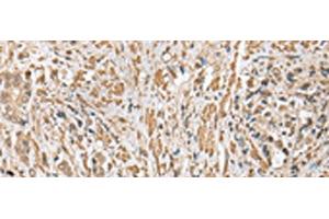 Immunohistochemistry of paraffin-embedded Human prost ate cancer tissue using CNPY2 Polyclonal Antibody at dilution of 1:25(x200) (CNPY2/MSAP Antikörper)