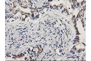 Immunohistochemical staining of paraffin-embedded Carcinoma of Human lung tissue using anti-PNMT mouse monoclonal antibody.