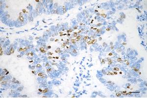 Immunohistochemistry was performed on paraffin-embedded human sigmoid colon carcinoma using DNA topoisomerase II alpha antibody (ABIN7800574), 1:200). (Rekombinanter Topoisomerase II alpha Antikörper)