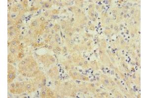 Immunohistochemistry of paraffin-embedded human liver cancer using ABIN7151102 at dilution of 1:100 (Pellino 3 Antikörper  (AA 1-280))
