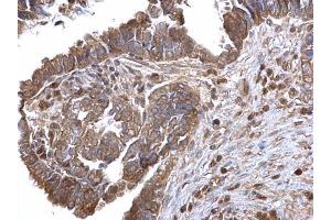 IHC-P Image LOXL2 antibody detects LOXL2 protein at cytosol on human ovarian carcinoma by immunohistochemical analysis. (LOXL2 Antikörper)
