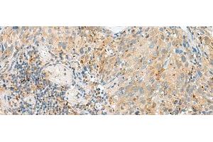 Immunohistochemistry of paraffin-embedded Human cervical cancer tissue using CNPY3 Polyclonal Antibody at dilution of 1:55(x200) (TNRC5 Antikörper)