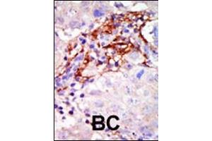 Formalin-fixed and paraffin-embedded human cancer tissue reacted with the primary antibody, which was peroxidase-conjugated to the secondary antibody, followed by AEC staining. (MAP2K3 Antikörper  (N-Term))