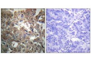 Immunohistochemistry analysis of paraffin-embedded human breast carcinoma tissue using XPA antibody. (XPA Antikörper  (C-Term))