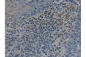 IHC-P analysis of Human Skin Cancer Tissue, with DAB staining. (CD25 Antikörper  (AA 22-213))