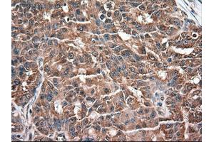Immunohistochemical staining of paraffin-embedded Adenocarcinoma of colon using anti-NTF3 (ABIN2452548) mouse monoclonal antibody. (Neurotrophin 3 Antikörper  (AA 139-257))