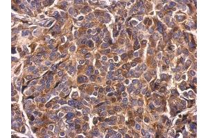IHC-P Image Survivin antibody detects Survivin protein at cytosol on human breast carcinoma by immunohistochemical analysis. (Survivin Antikörper)