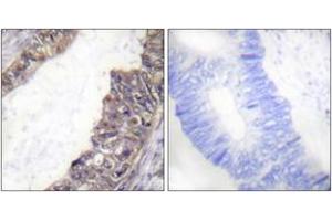Immunohistochemistry analysis of paraffin-embedded human colon carcinoma, using GIRK1/KIR3. (KCNJ3 Antikörper  (pSer185))