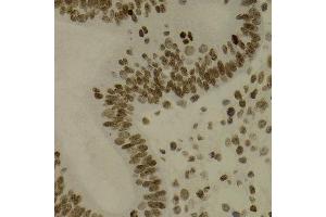 Immunohistochemistry of paraffin-embedded human uterine cancer using NFKB2 antibody at dilution of 1:200 (400x lens). (NFKB2 Antikörper)