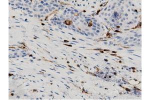 Immunohistochemical staining of paraffin-embedded Carcinoma of Human kidney tissue using anti-ARHGAP25 mouse monoclonal antibody. (ARHGAP25 Antikörper)