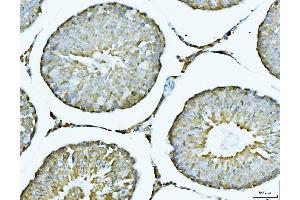 IHC analysis of ACLY using anti-ACLY antibody (ABIN4886416). (ACLY Antikörper  (AA 1-180))
