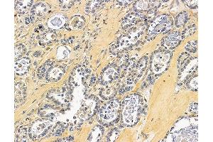ABIN7096455 and ABIN7100519 at 1/100 staining human ovarian cancer by IHC-P. (CHM Antikörper)