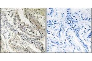 Immunohistochemistry analysis of paraffin-embedded human lung carcinoma tissue, using CRBP III Antibody. (Retinol Binding Protein 5 Antikörper  (AA 10-59))
