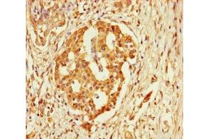 Immunohistochemistry of paraffin-embedded human pancreatic cancer using ABIN7152927 at dilution of 1:100 (FBLN7 Antikörper  (AA 25-393))