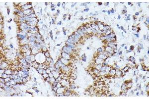 Immunohistochemistry of paraffin-embedded Human colon carcinoma using PPP2CB Polyclonal Antibody at dilution of 1:100 (40x lens). (PPP2CB Antikörper)