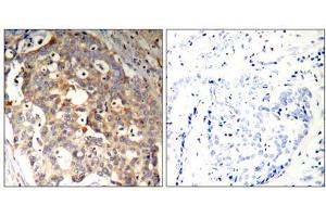 Immunohistochemical analysis of paraffin-embedded human breast carcinoma tissue using SAPK/JNK (Ab-183) Antibody (E021241). (SAPK, JNK Antikörper)