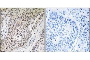Immunohistochemistry analysis of paraffin-embedded human lung carcinoma tissue, using ZNF608 Antibody. (ZNF608 Antikörper  (AA 1231-1280))