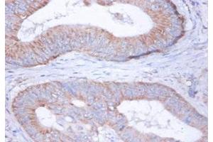 Immunohistochemistry of paraffin-embedded human colon cancer using ABIN7149114 at dilution of 1:100 (UQCRFS1 Antikörper  (AA 79-274))