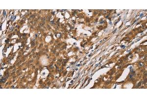 Immunohistochemistry of paraffin-embedded Human gasrtic cancer tissue using DICER1 Polyclonal Antibody at dilution 1:40 (DICER1 Antikörper)