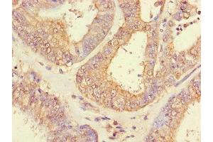 Immunohistochemistry of paraffin-embedded human endometrial cancer using ABIN7151005 at dilution of 1:100 (CHFR Antikörper  (AA 141-422))