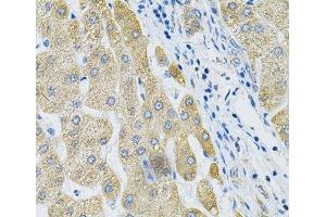 Immunohistochemistry of paraffin-embedded Human liver cancer using ALG2 Polyclonal Antibody at dilution of 1:100 (40x lens). (ALG2 Antikörper)