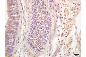 Formalin-fixed and paraffin embedded human lung carcinoma labeled with Anti-Ribonuclease Inhibitor Polyclonal Antibody, Unconjugated (ABIN872914) at 1:200 followed by conjugation to the secondary antibody and DAB staining. (RNH1 Antikörper  (AA 101-200))