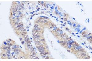 Immunohistochemistry of paraffin-embedded Human colon carcinoma using RBM39 Polyclonal Antibody at dilution of 1:100 (40x lens).