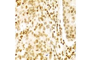 Immunohistochemistry of paraffin-embedded human gastric cancer using DKC1 Antibody (ABIN5970956) at dilution of 1/100 (40x lens). (DKC1 Antikörper)