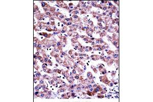 GDI2 Antibody (Center) ((ABIN657709 and ABIN2846700))immunohistochemistry analysis in formalin fixed and paraffin embedded human liver tissue followed by peroxidase conjugation of the secondary antibody and DAB staining. (GDI2 Antikörper  (AA 135-164))