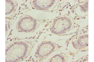 Immunohistochemistry of paraffin-embedded human colon cancer using ABIN7167697 at dilution of 1:100 (RPA2 Antikörper  (AA 1-267))