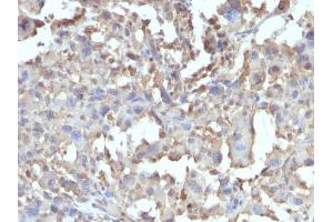 Formalin-fixed, paraffin-embedded human Histiocytoma stained with TNF alpha Rabbit Recombinant Monoclonal Antibody (TNF/1500R). (Rekombinanter TNF alpha Antikörper)