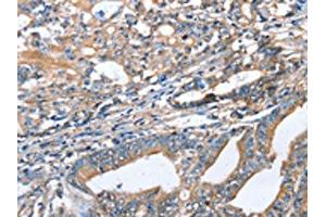 The image on the left is immunohistochemistry of paraffin-embedded Human gastric cancer tissue using ABIN7128332(AKR1D1 Antibody) at dilution 1/35, on the right is treated with fusion protein. (AKR1D1 Antikörper)