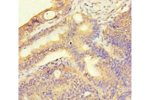 Immunohistochemistry of paraffin-embedded human colon cancer using ABIN7171536 at dilution of 1:100 (TAS2R13 Antikörper  (AA 150-184))