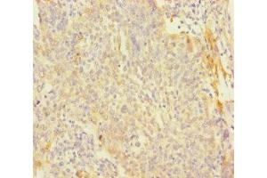 Immunohistochemistry of paraffin-embedded human cervical cancer using ABIN7166699 at dilution of 1:100 (PAGE2B Antikörper  (AA 1-111))