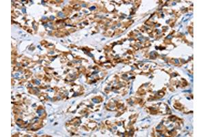 The image on the left is immunohistochemistry of paraffin-embedded Human thyroid cancer tissue using ABIN7129698(HINT2 Antibody) at dilution 1/40, on the right is treated with fusion protein. (HINT2 Antikörper)