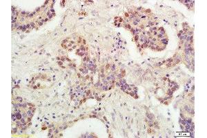 Formalin-fixed and paraffin embedded human ovarian carcinoma labeled with Rabbit Anti-P53 protein(wt-p53) Polyclonal Antibody , Unconjugated 1:300 followed by conjugation to the secondary antibody and DAB staining (p53 Antikörper  (AA 251-310))