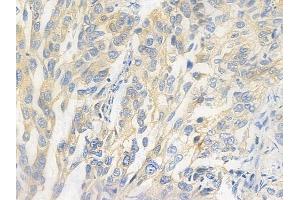 ABIN6265789 and ABIN6278090 at 1/100 staining human lung squamous cell carcinoma by IHC-P.