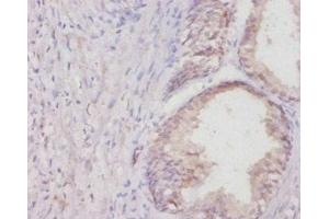 Immunohistochemistry of paraffin-embedded human colon cancer using ABIN7178837 at dilution of 1:20 (COL1A1 Antikörper  (AA 955-1207))