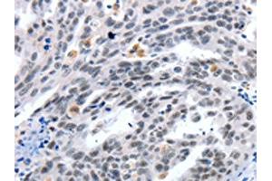The image on the left is immunohistochemistry of paraffin-embedded Human ovarian cancer tissue using ABIN7191321(LRP5 Antibody) at dilution 1/55, on the right is treated with synthetic peptide. (LRP5 Antikörper)