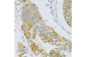 Immunohistochemistry of paraffin-embedded human gastric carcinoma using MBL2 antibody (ABIN6132334, ABIN6143597, ABIN6143600 and ABIN6221519) at dilution of 1:100 (40x lens). (MBL2 Antikörper  (AA 21-248))